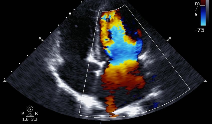 Ecocardiogramma Color Doppler
